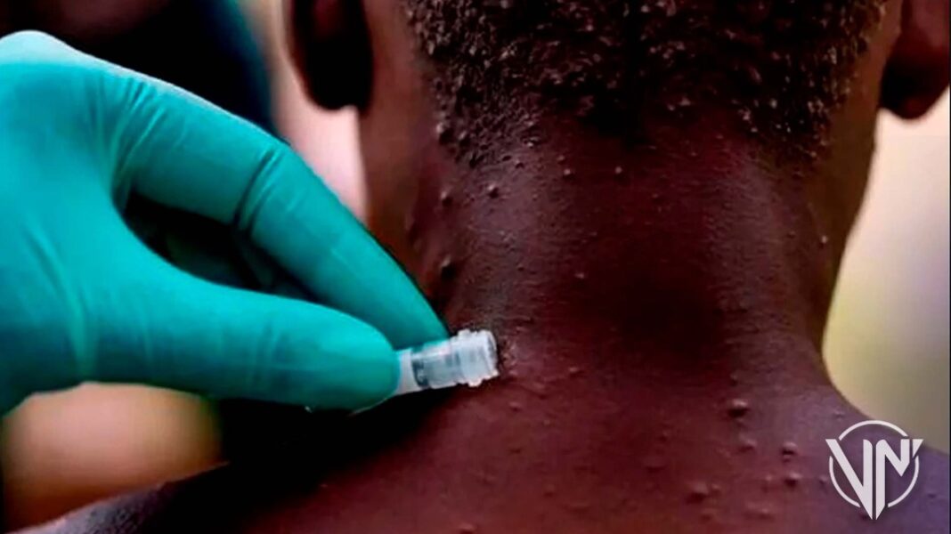 Farmacéutica Moderna prueba vacunas contra la viruela del mono