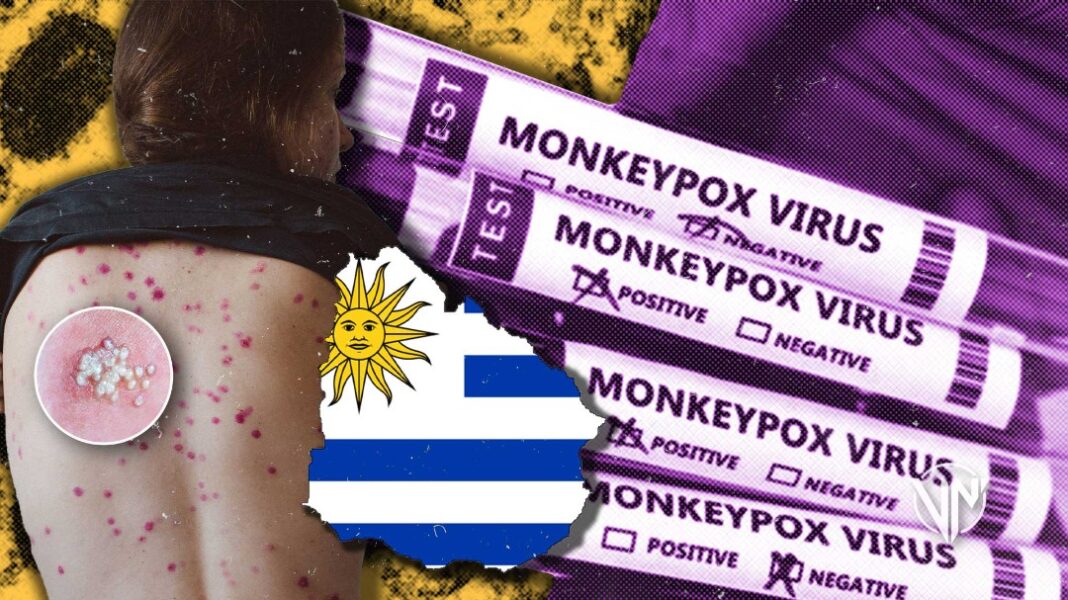 Uruguay analiza cuatro casos sospechosos de Viruela del Mono
