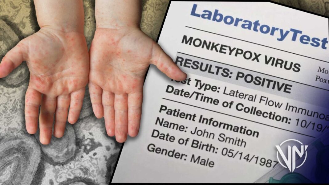 OMS aumenta a 780 los casos de viruela del mono a nivel mundial
