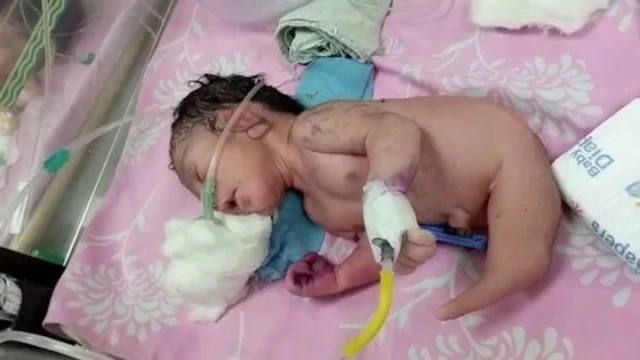 Bebé prematuro nació con un cuerno en vez de piernas