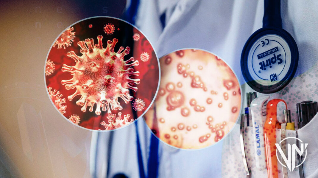 Reporta primera muerte por viruela símica en Estados Unidos