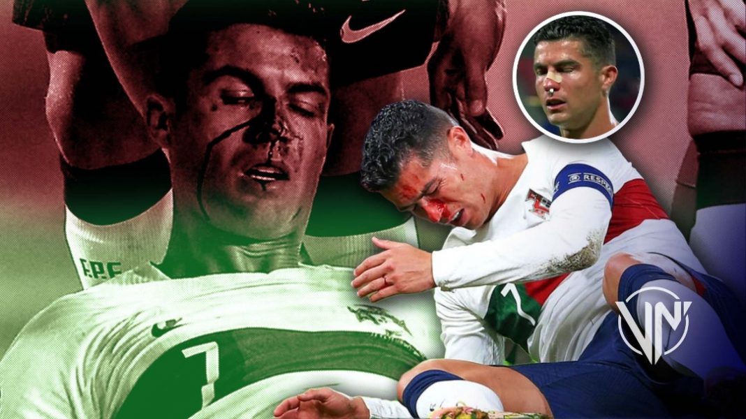 Cristiano Ronaldo nariz rota