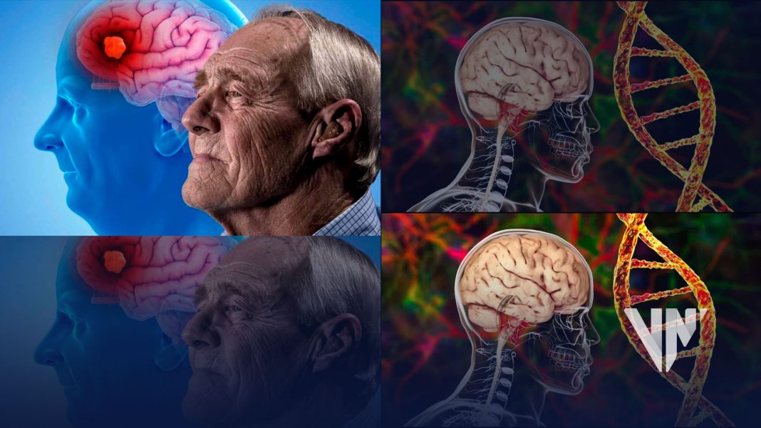 Lecanemab con resultados alentadores contra el Alzheimer