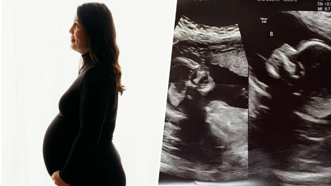 Mujer 32 años embarazada dos úteros