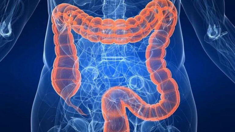 síndrome de colon irritable