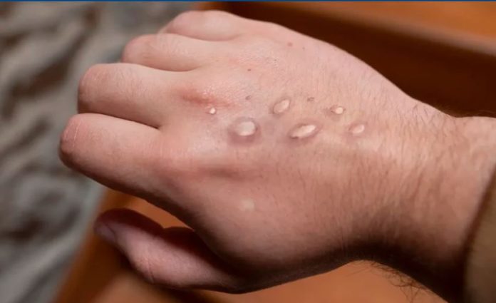 Pakistán refuerza vigilancia sanitaria tras detectar nuevo caso de viruela símica viruela símica Pakistán
